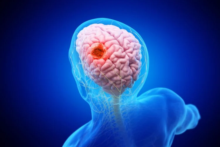 Nanoparticle “double punch” could help surgeons find and destroy hidden glioblastoma cells